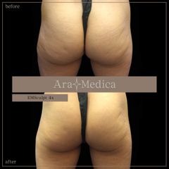 EmSculpt - Clinica AraMedica