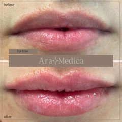Filler Labbra - Clinica AraMedica