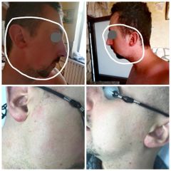 Rosacea - Dott Luigi Petti