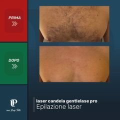 Depilazione laser - Dott Luigi Petti