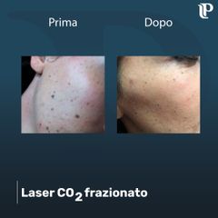 Laser CO2 frazionato - Dott Luigi Petti