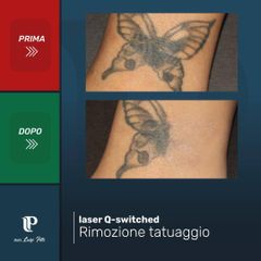 Rimozione tatuaggi - Dott Luigi Petti