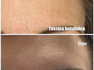 Botulino prima e dopo