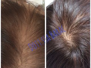 Mesoterapia capelli prima e dopo