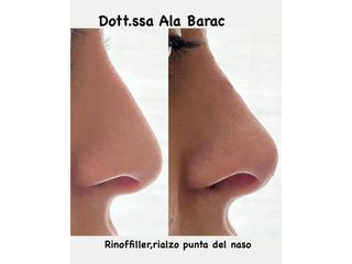 Rinofiller - Dott.ssa Ala Barac