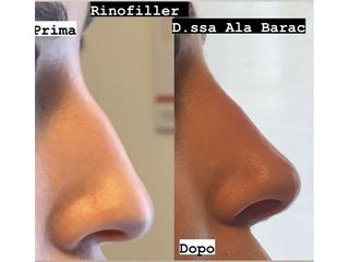 Rinofiller - Dott.ssa Ala Barac