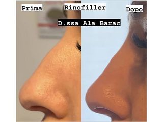 Rinofiller - Dott.ssa Ala Barac