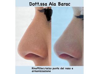 Rinofiller - Dott.ssa Ala Barac