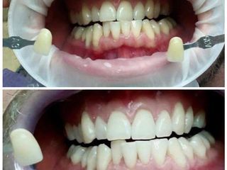 Sbiancamento Dentale prima e dopo