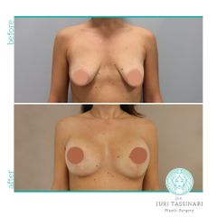 Mastopessi - Dr. Juri Tassinari