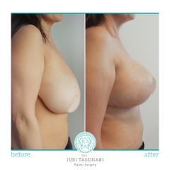 Mastoplastica riduttiva - Dr. Juri Tassinari