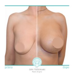 Mastopessi - Dr. Juri Tassinari
