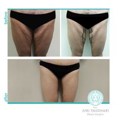 Liposuzione - Dr. Juri Tassinari
