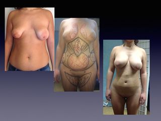 Liposcultura prima e dopo