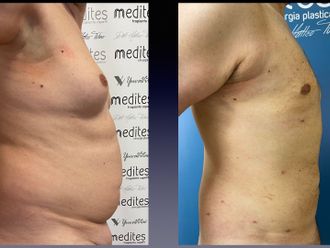Lipo Vaser prima e dopo - 875712