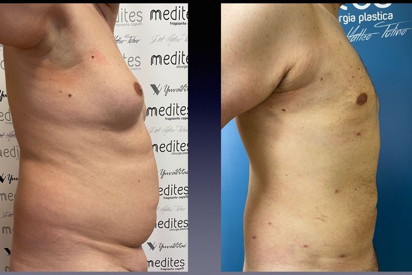 Lipo Vaser prima e dopo - 875712