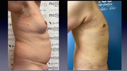 Lipo Vaser - Medites