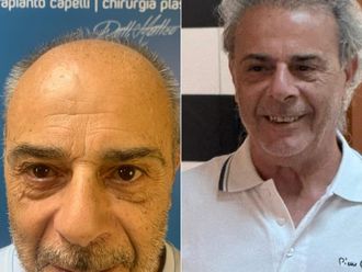 Trapianto capelli prima e dopo - 875713