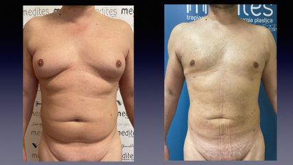 Liposcultura - Medites