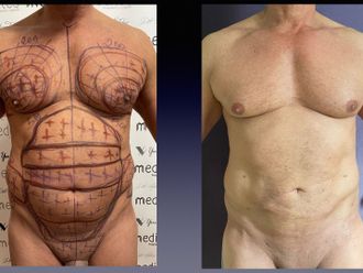 Lipo Vaser prima e dopo - 875715