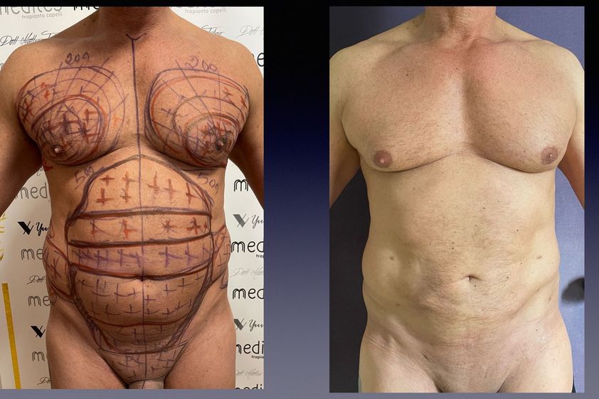 Lipo Vaser prima e dopo - 875715