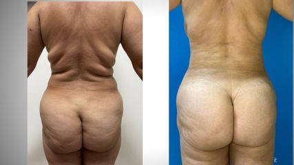 Liposcultura - Medites