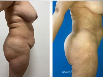 Liposcultura prima e dopo - 875718