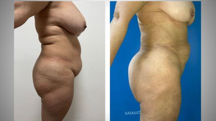 Liposcultura - Medites