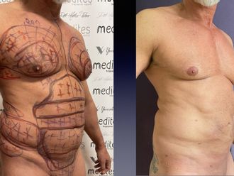 Lipo Vaser prima e dopo - 875719