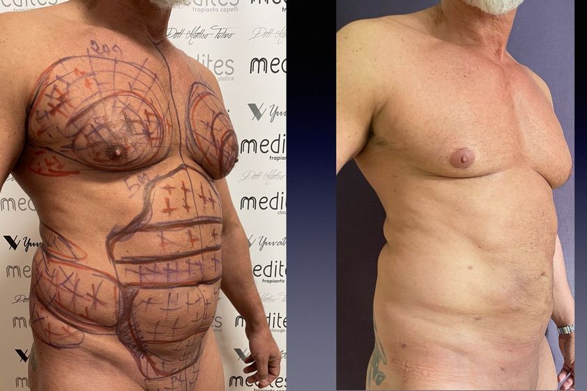 Lipo Vaser prima e dopo - 875719