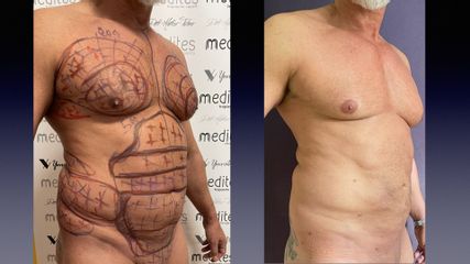 Lipo Vaser - Medites