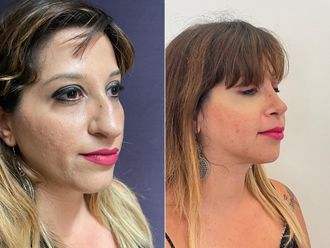 Rinoplastica prima e dopo - 876266