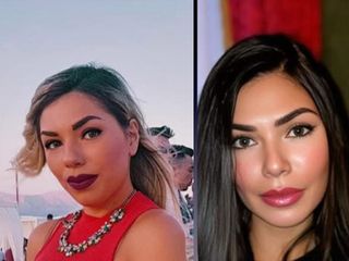 Dott. Matteo Tutino Pre e Post operatorio Rinoplastica mentoplastica e definizione del contorno mand