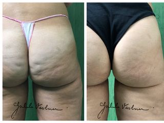 Liposcultura prima e dopo