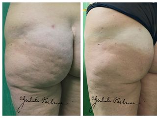 Liposcultura prima e dopo