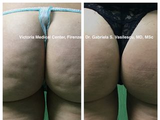 Cellfina prima e dopo