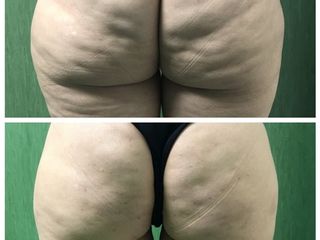 Liposcultura prima e dopo