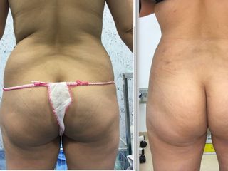 Liposcultura prima e dopo