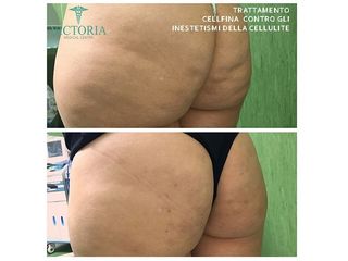 Cellfina prima e dopo