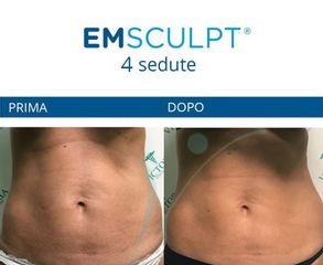 EmScultp prima e dopo
