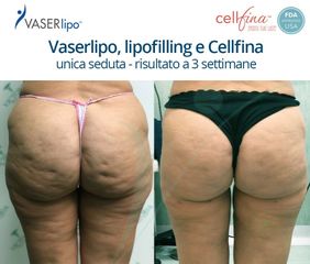 Cellfina prima e dopo