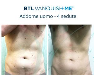 Vanquish prima e dopo