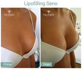 Lipofilling seno prima e dopo