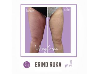 Lifting cosce - Dott. Erind Ruka