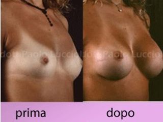 Mastoplastica additiva prima e dopo