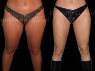 Liposcultura prima e dopo