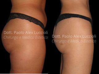 Liposcultura prima e dopo
