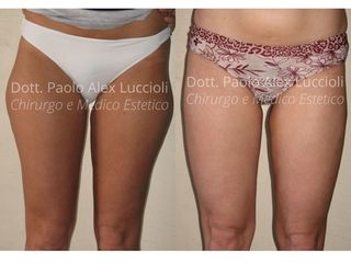 Liposcultura prima e dopo
