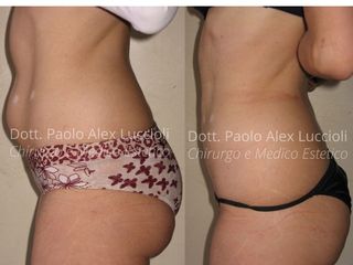 Liposcultura prima e dopo