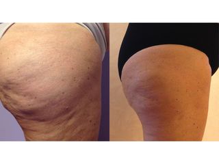 Cellulite - Dott.ssa Rosaria D'Ambrosio